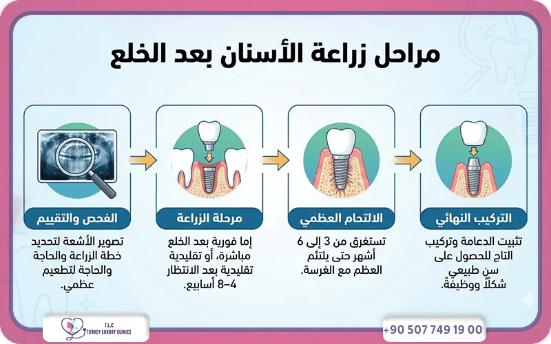 مراحل زراعة الأسنان بعد الخلع: من الجراحة حتى التاج النهائي