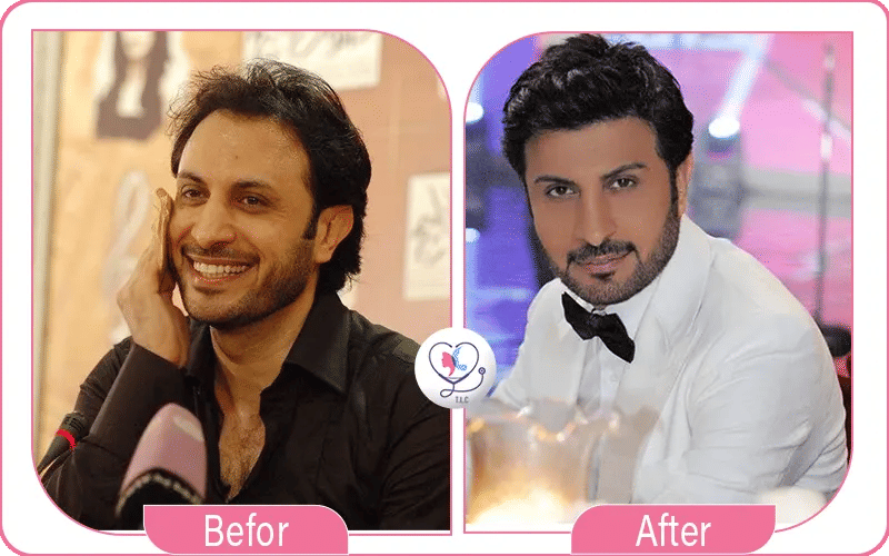 مقارنة بين نتائج زرع الشعر قبل و بعد لدى ماجد المهندس: