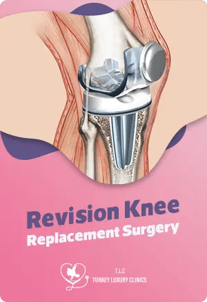 Revision Knee Replacement Surgery
