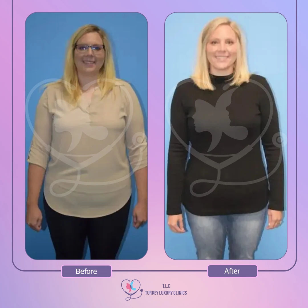 الفرق بين تكميم المعدة و باقي جراحات السمنة