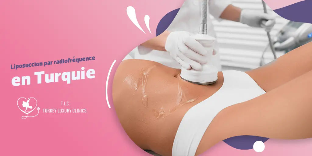 Liposuccion par radiofréquence en Turquie : remodelage corporel innovant