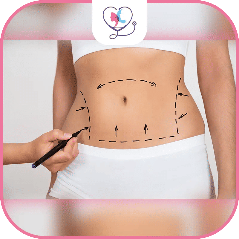 Y a-t-il une différence entre la grossesse après liposuccion du ventre et après abdominoplastie ?