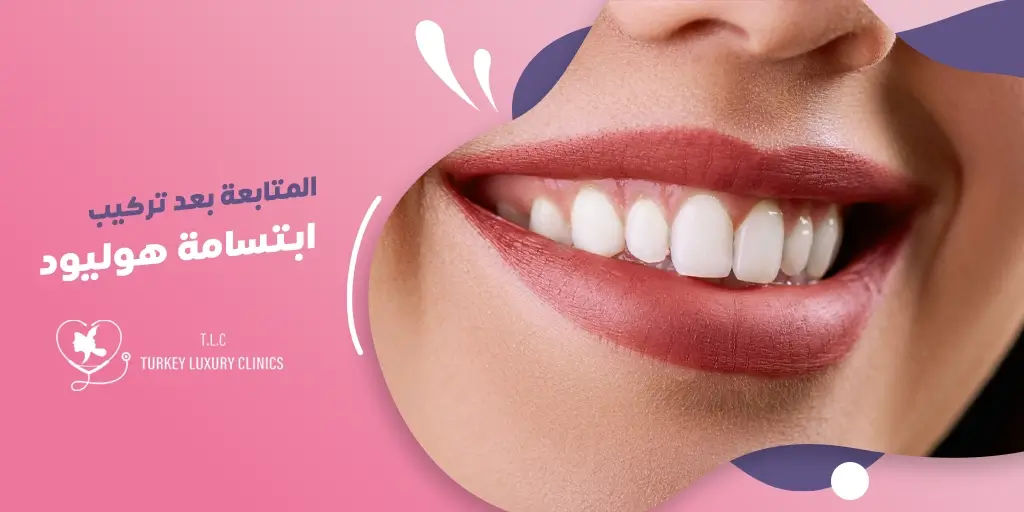 المتابعة بعد تركيب ابتسامة هوليود