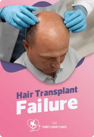 Hair Transplant Failurefeatured image