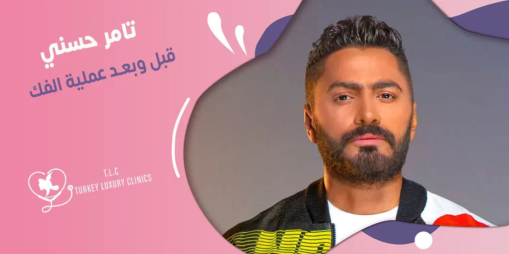 تامر حسني قبل وبعد عملية الفك: شاهد النتائج بالصور