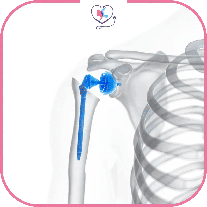 ما هي تكلفة استبدال مفصل الكتف في تركيا؟