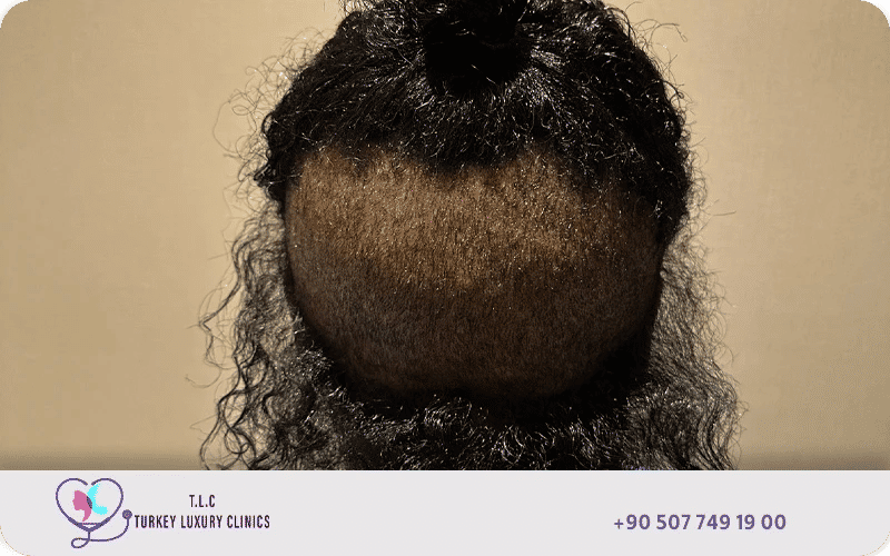Back view of a patient's head showing hair transplant results comparing different hair restoration techniques like FUE and DHI