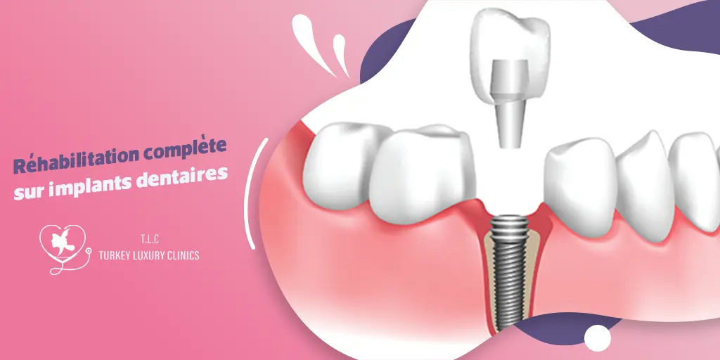 Réhabilitation complète sur implants dentaires : Solutions durables