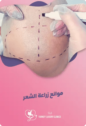 موانع زراعة الشعر وأبرز الحالات غير المؤهلة للعمليةfeatured image