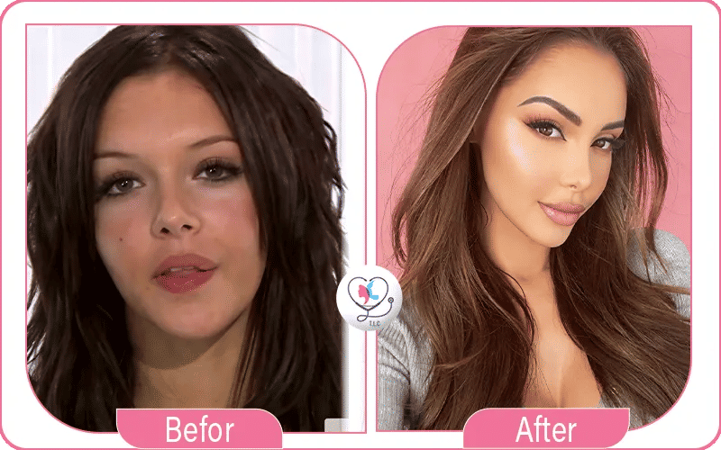 Nabilla après la chirurgie esthétique