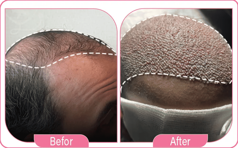 Top Clinics For Hair Transplant in Turkey