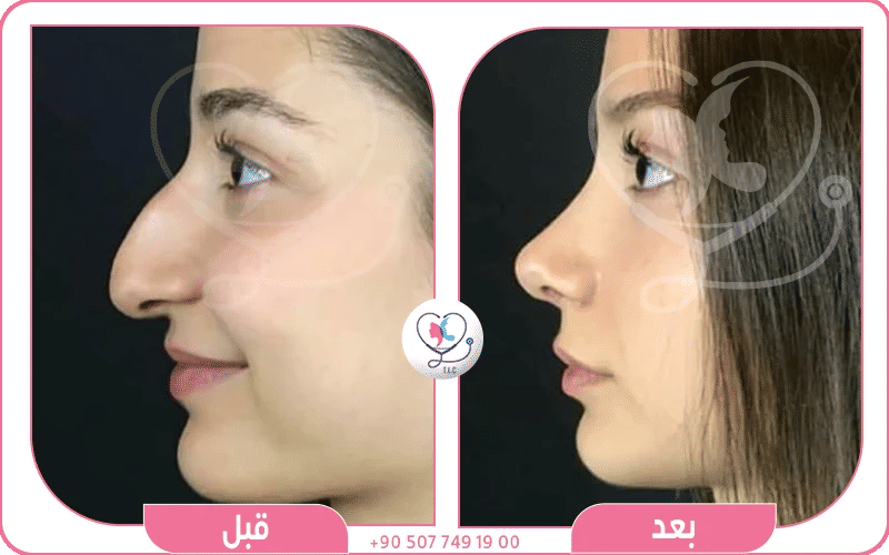 العمليات الجراحية (Rhinoplasty)