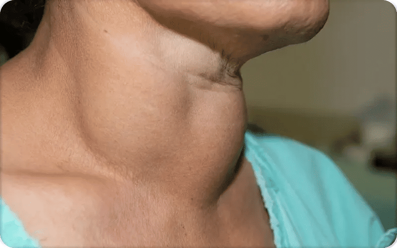 تضخم الغدة الدرقية عند النساء