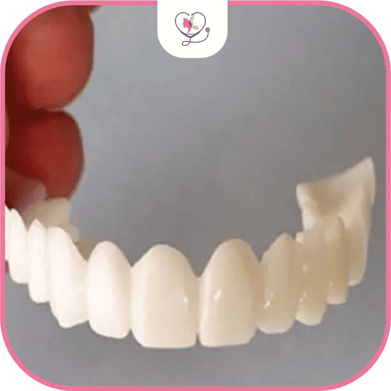 ابتسامة هوليود المتحركة