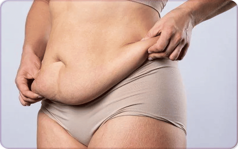 Qu’est-ce que l’abdominoplastie ?