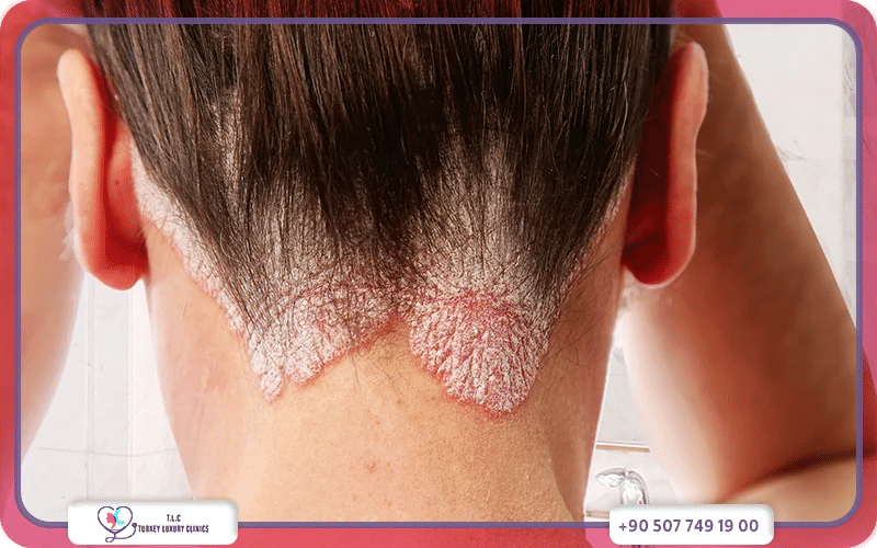 شكل صدفية الشعر