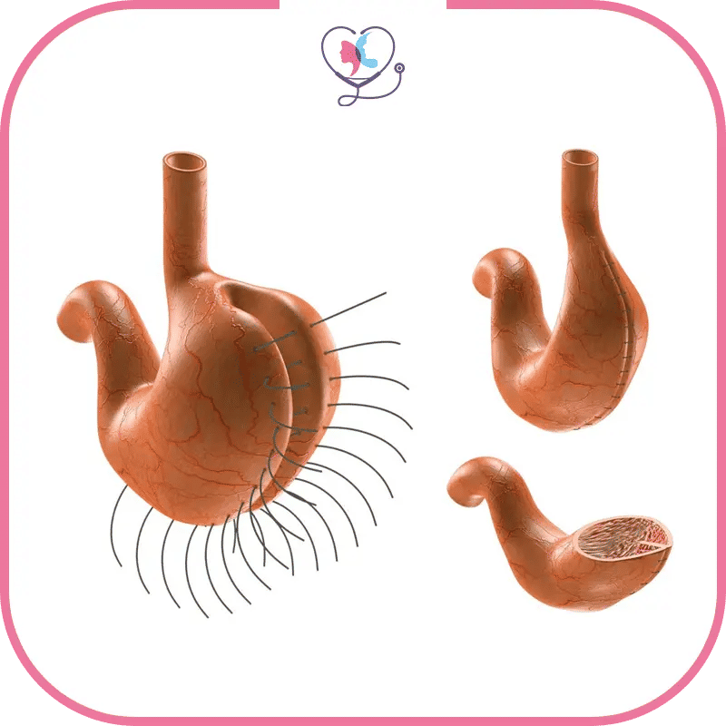 مدة التعافي من عملية التكميم في الشّهر الأول