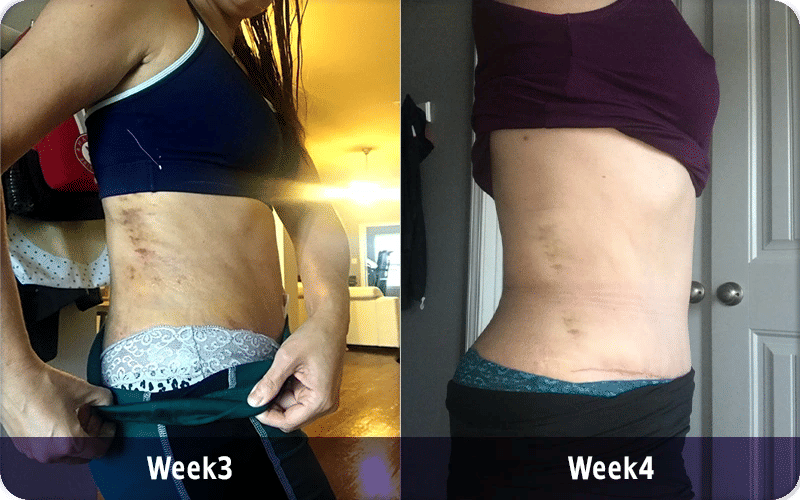 3 Weeks After Tummy Tuck