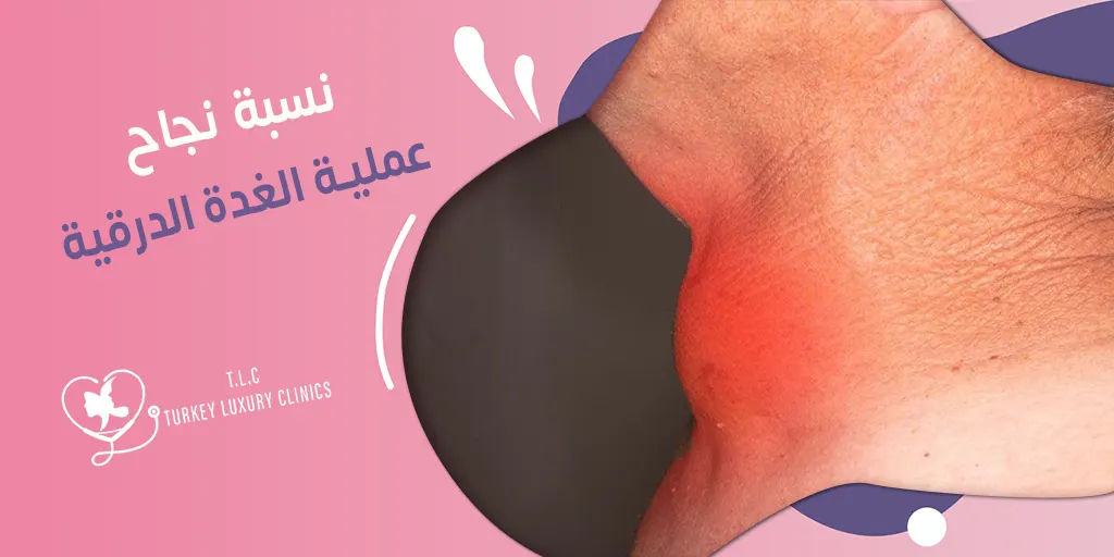 نسبة نجاح عملية الغدة الدرقية: 95 - 98% في معظم الحالات