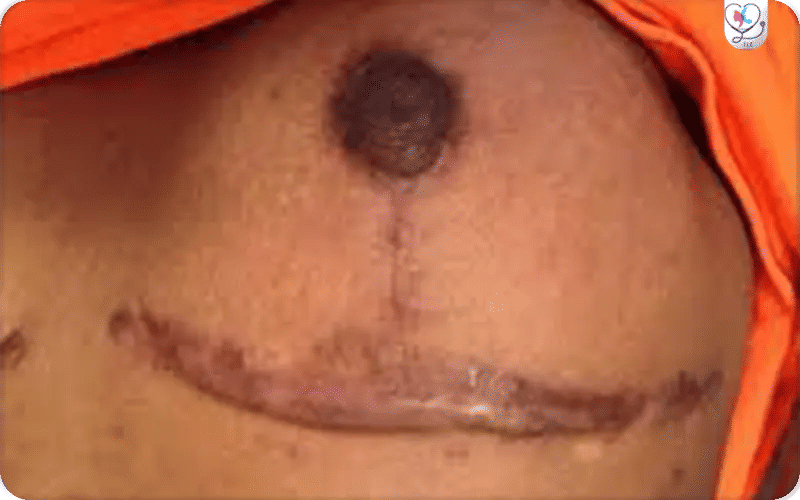 Unusual Scars During Breast Reduction Scar Timeline