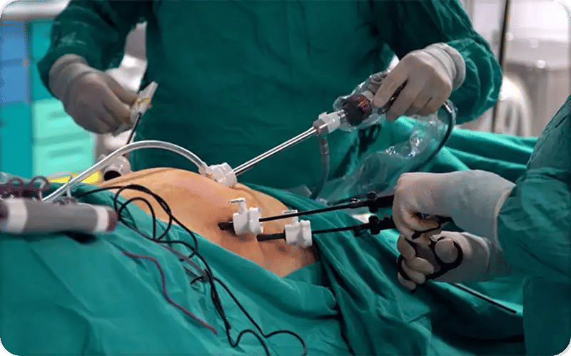 Qu’est-ce que l’opération sleeve gastrectomie ?