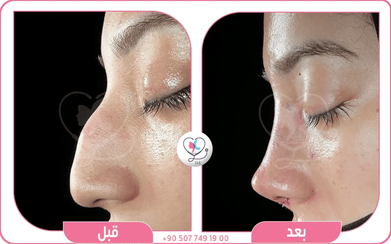 كم سعر عملية تجميل الانف في السعودي