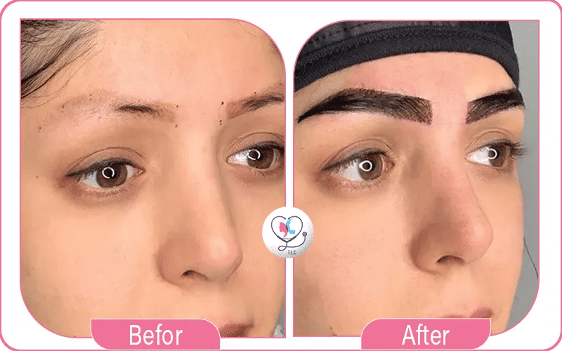 Why Eyebrow Transplants Are Cheaper in Turkey