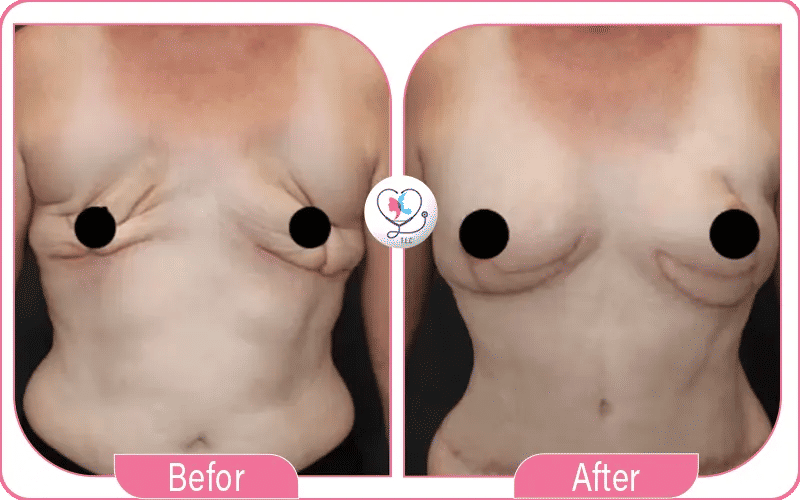 Pourquoi choisir turkey luxury clinic pour reconstruction mammaire après mastectomie