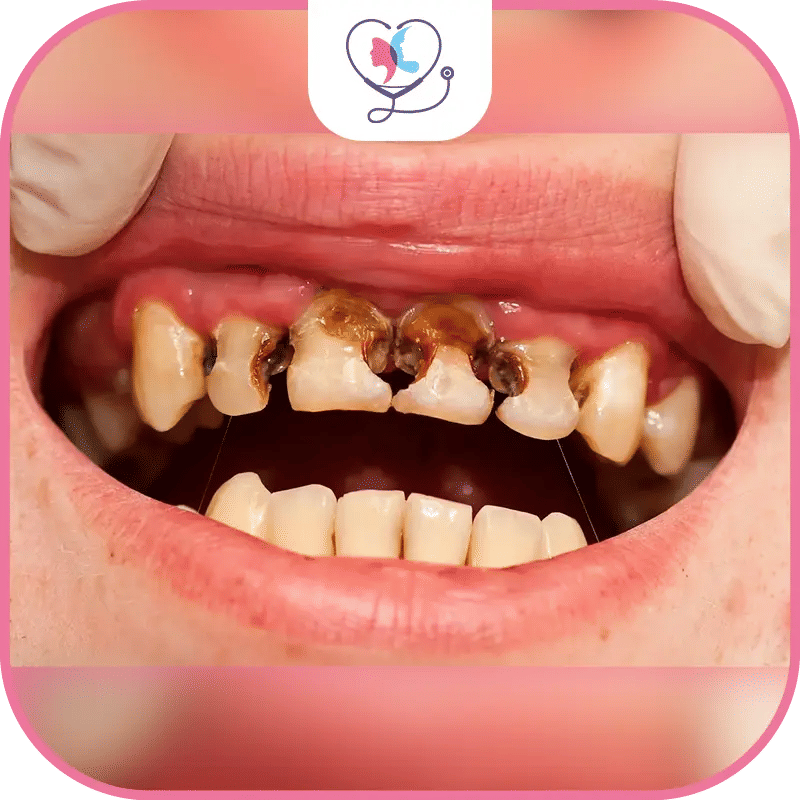 ماهو تسوس الاسنان الامامية؟