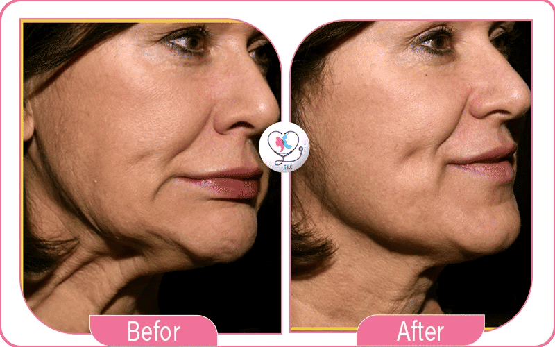 What is a Nefertiti Neck Lift Before and After?