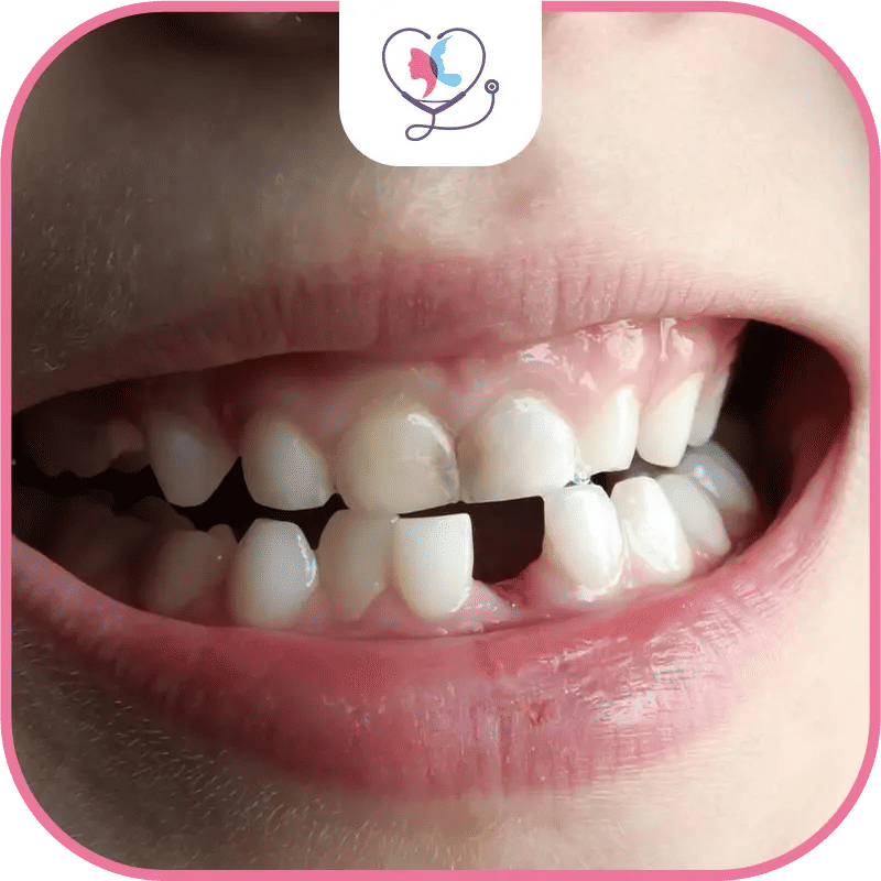 conséquences-d'une-perte-de-dents-chez-les-enfants-et-les-adolescents
