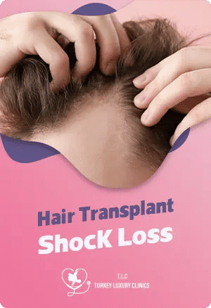 Hair Transplant Shock Loss
