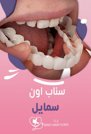 سناب اون سمايل: هل هي مناسبة لك؟ وماهي الأنواع والأسعار؟