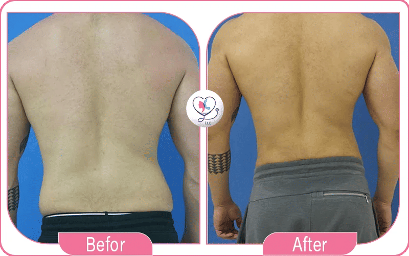 5. Mid Back: Lipo 360 12 Areas