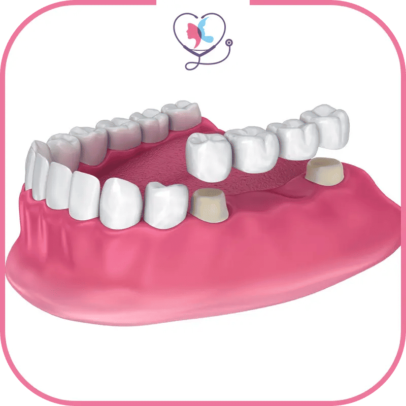 فوائد تلبيس الأسنان