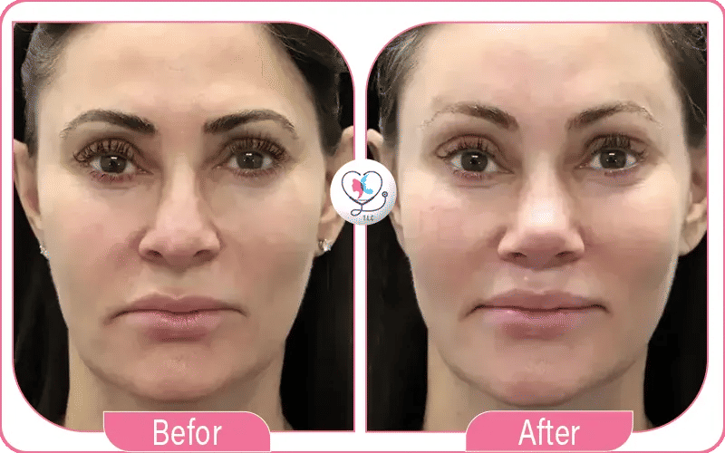 تجربتي مع رفع الحواجب البوتكس