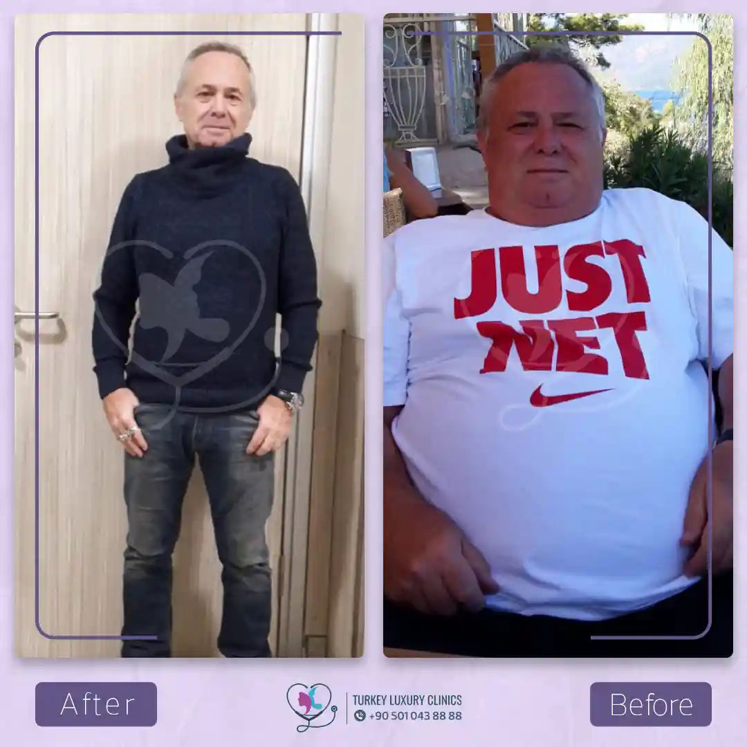 أسعار جراحة السمنة في تركيا لاكشري كلنيك