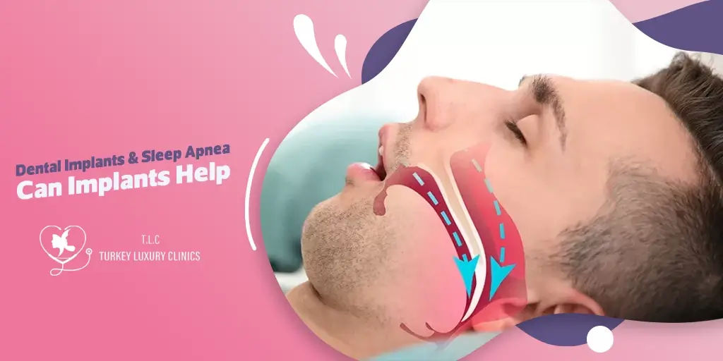 Zahnimplantate & Schlafapnoe: Können Implantate helfen?