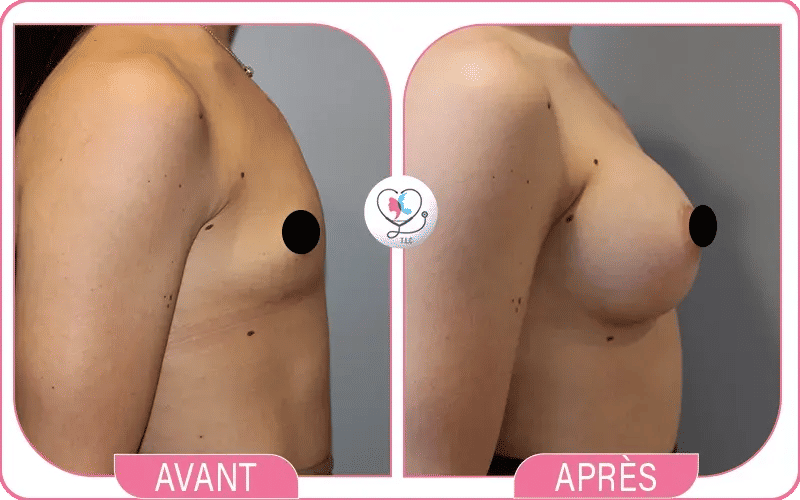 1. L’augmentation mammaire