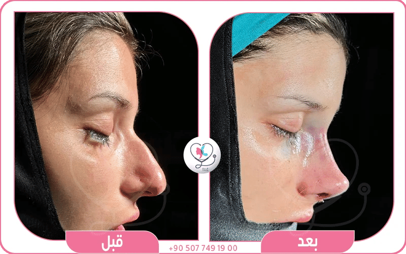 عمليات التجميل الأنف في تركيا 2026