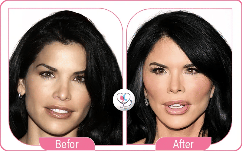Lauren Sanchez Eyes and Brows Before and After