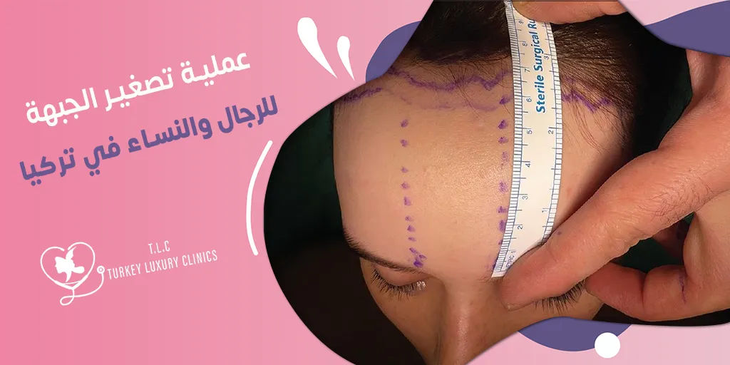 عملية تصغير الجبهة: الرجال والنساء والأسعار في تركيا