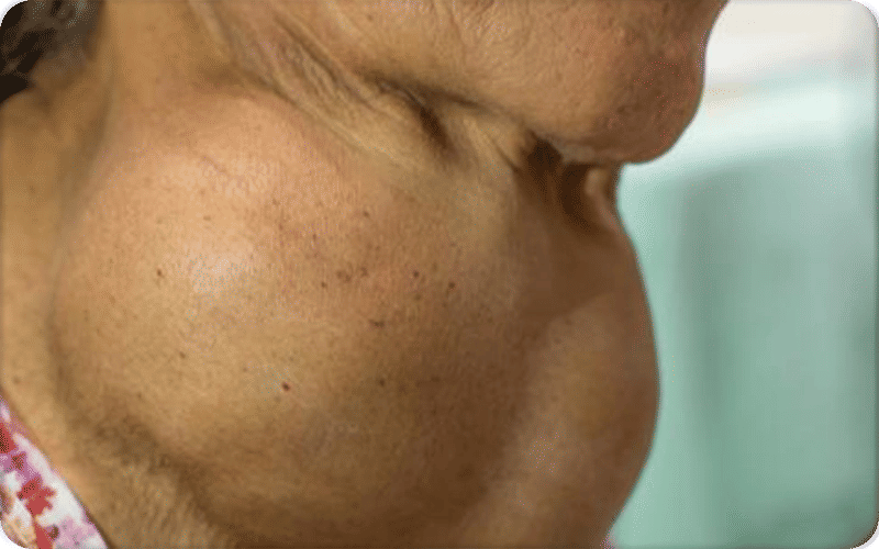 أنواع أمراض الغدة الدرقية عند النساء