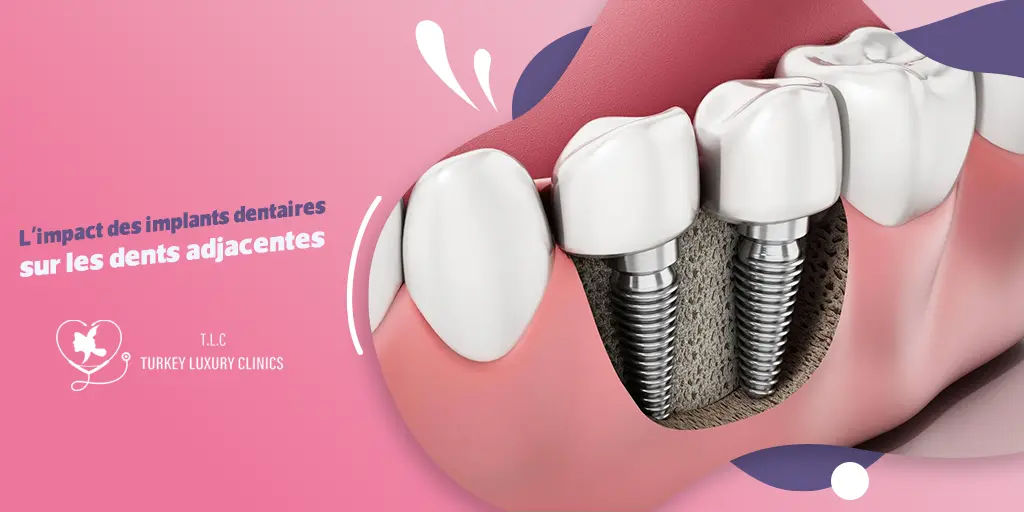 L'impact des implants dentaires sur les dents adjacentes