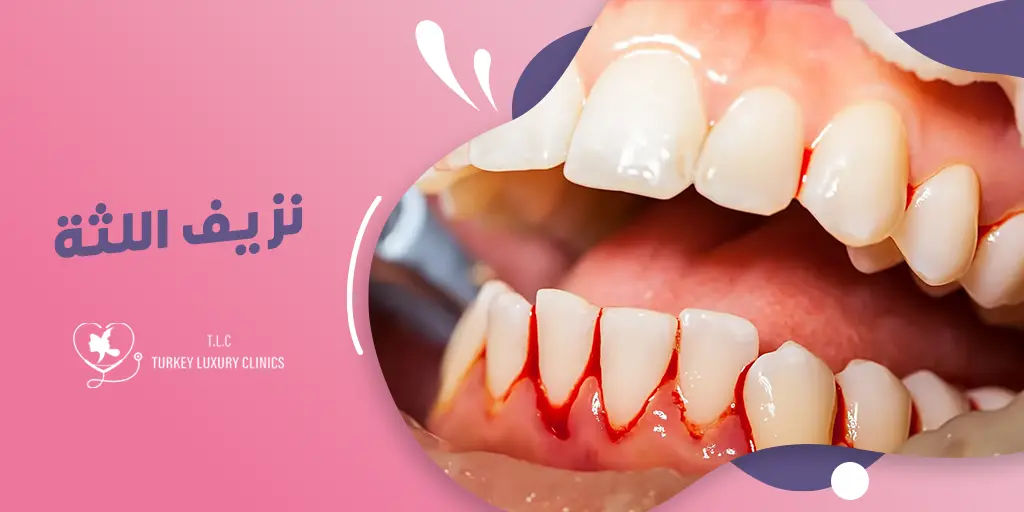 نزيف اللثة: ما هي أسبابه وطرق فعالة لإيقافه والحفاظ على لثة صحية؟