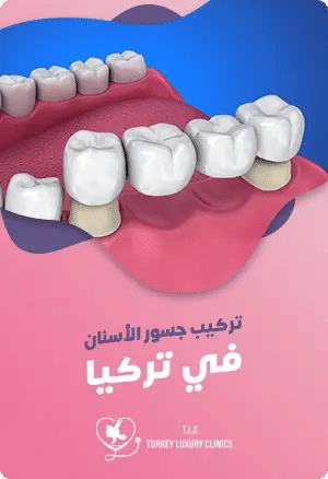 تركيب جسور الأسنان في تركياfeatured image