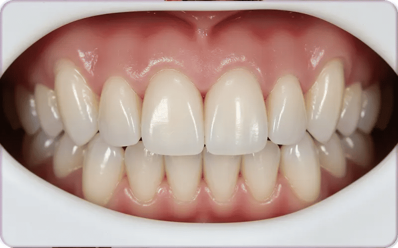 What Do Teeth Look Like Under Veneers?
