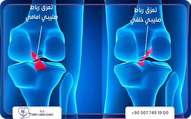 الفرق بين أعراض تمزق الرباط الصليبي حسب نوع الإصابة