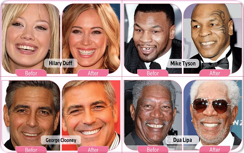 Celebrity Dental Implants Before and After