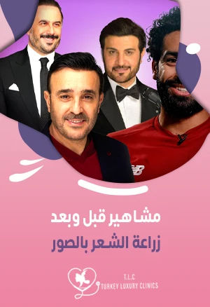 مشاهير قبل وبعد زراعة الشعر بالصور: (عرب وأجانب)